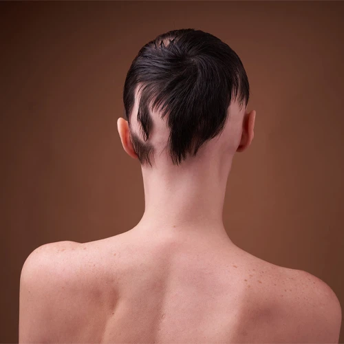 Alopecia